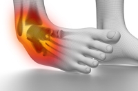 Grades of Ankle Sprains