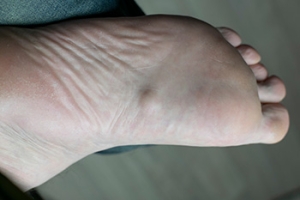 Risk Factors of Plantar Fibromatosis