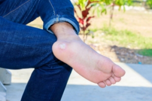 Plantar Warts Defined