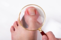 Understanding and Relieving Ingrown Toenails