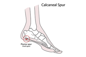 Understanding Heel Spurs