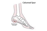 Understanding Heel Spurs