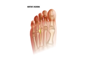 Morton’s Neuroma Facts