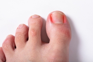 Preventing Painful Ingrown Toenails